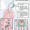 Como funciona a Gripe - Sintomas, Proteção e Tratamento